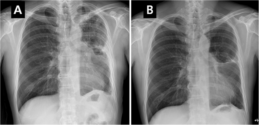 X-ray-findings-of-resolving-the-acute-pneumonitis-A-follow-up-chest-X-ray-showed-a
