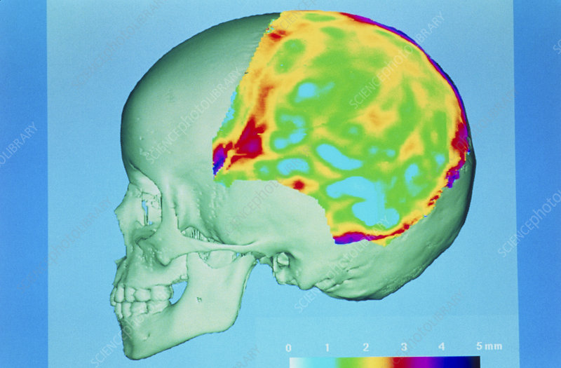 3-D CT scan of human skull showing bone thickness