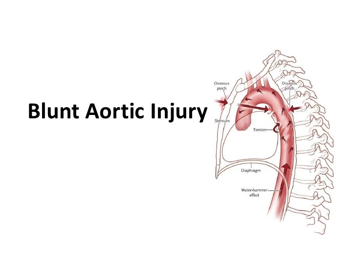 blunt-aortic-injury-1-728